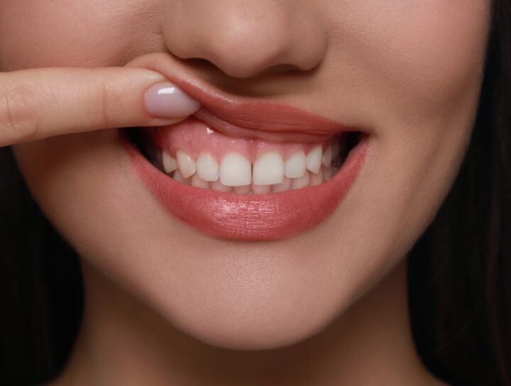 Frenulectomia | Studio Dentistico Stramesi
