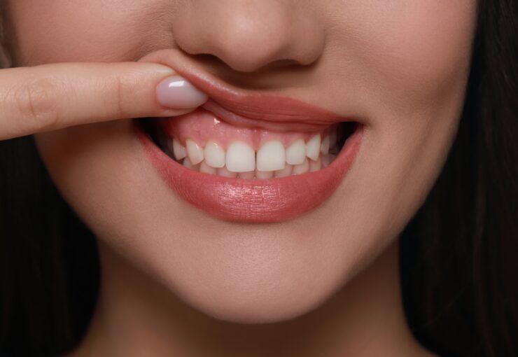 Frenulectomia | Studio Dentistico Stramesi