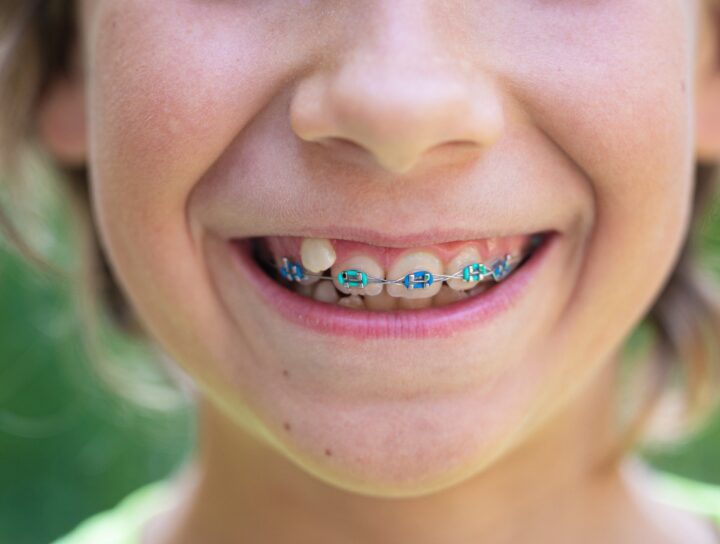Mettere l'apparecchio ai bambini: una guida per i genitori | Studio Dentistico Stramesi