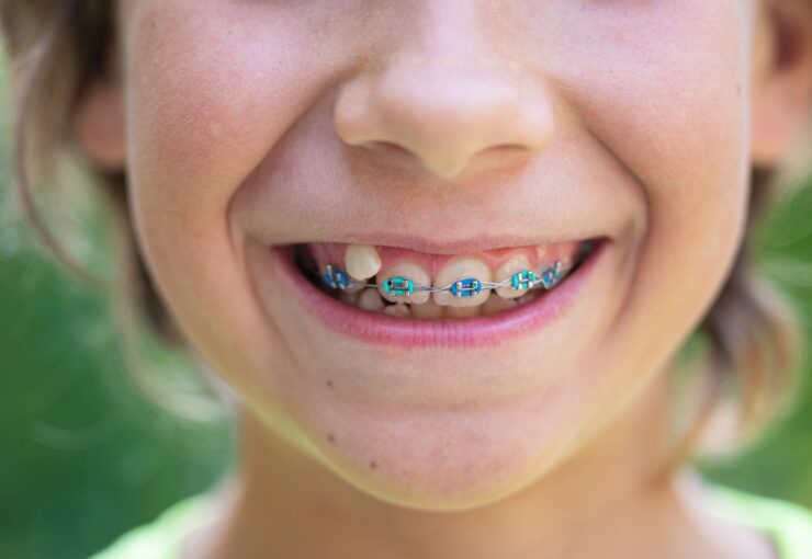 Mettere l'apparecchio ai bambini: una guida per i genitori | Studio Dentistico Stramesi