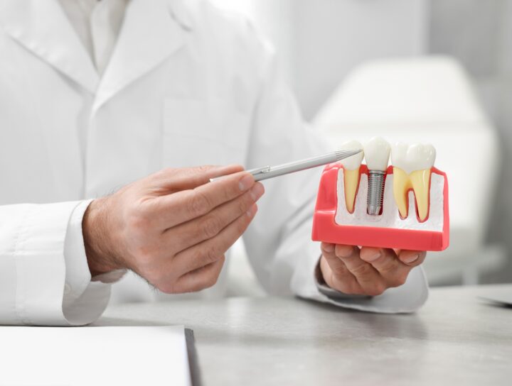 Impianti Dentali: soluzioni per rinnovare il proprio sorriso | Studio Dentistico Stramesi