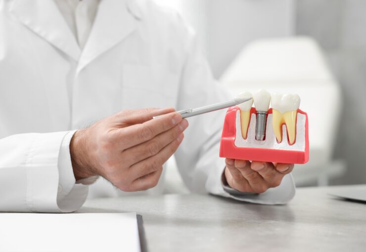 Impianti Dentali: soluzioni per rinnovare il proprio sorriso | Studio Dentistico Stramesi