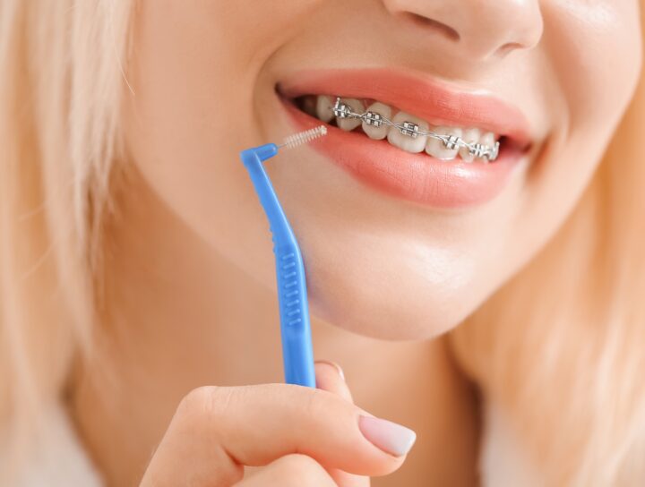 Come prendersi cura dei denti con l'apparecchio | blog | Studio Dentistico Stramesi Milano