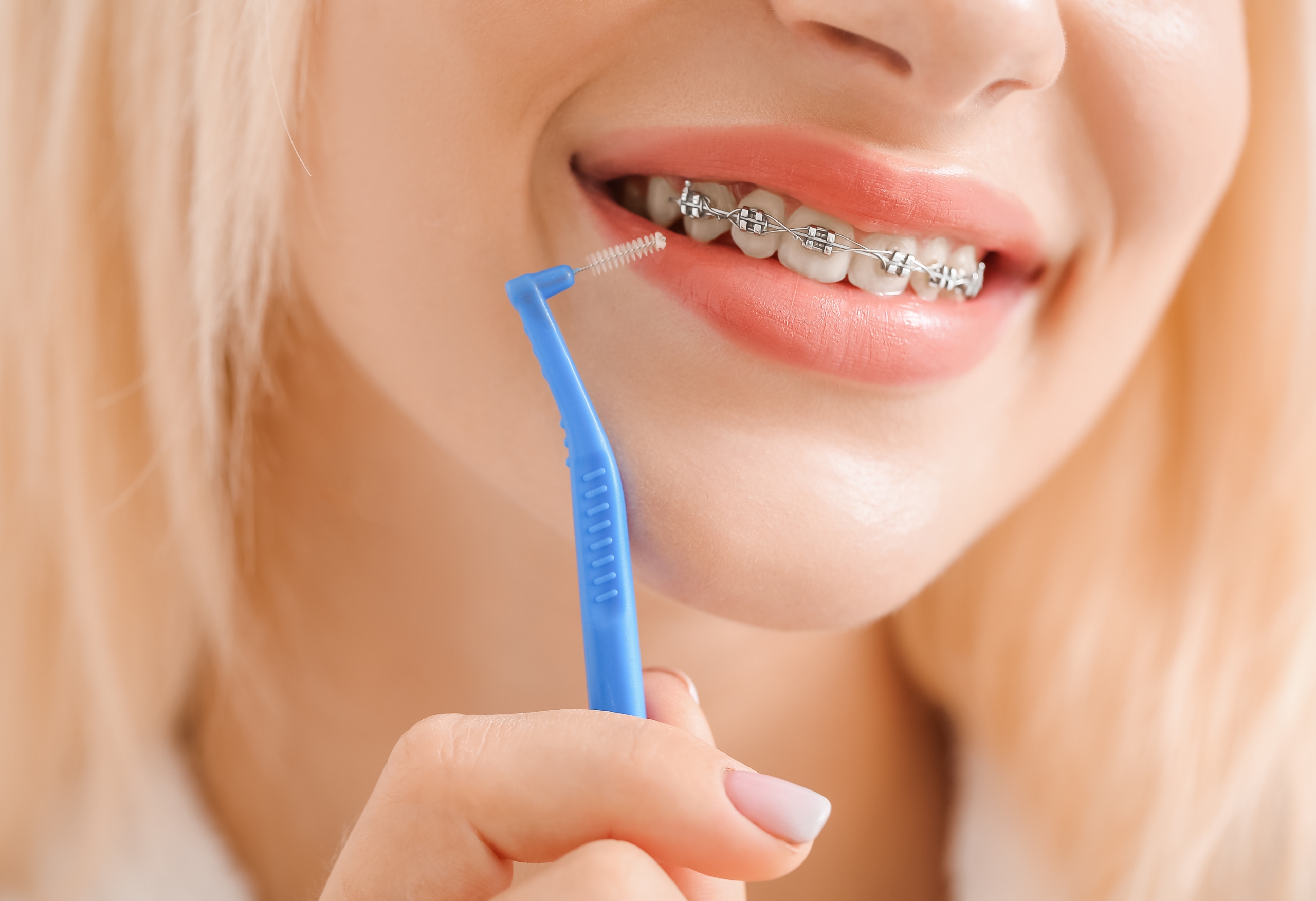 Come prendersi cura dei denti con l'apparecchio | blog | Studio Dentistico Stramesi Milano