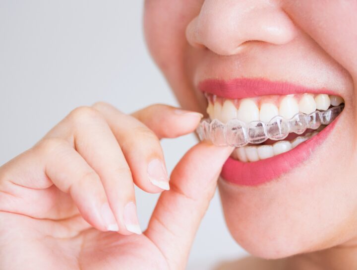 Ivisalign: pro e contro | Blog | Studio Dentistico Stramesi Milano