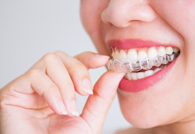 Ivisalign: pro e contro | Blog | Studio Dentistico Stramesi Milano
