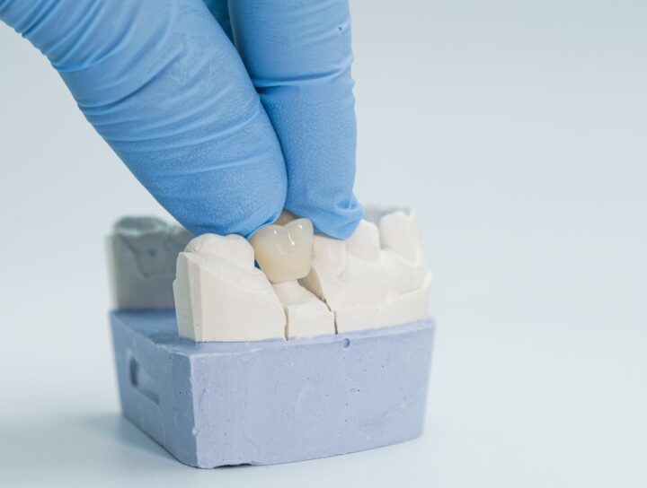 Corone Dentali: cosa sono e quando usarle - Studio Dentistico Stramesi Milano Blog