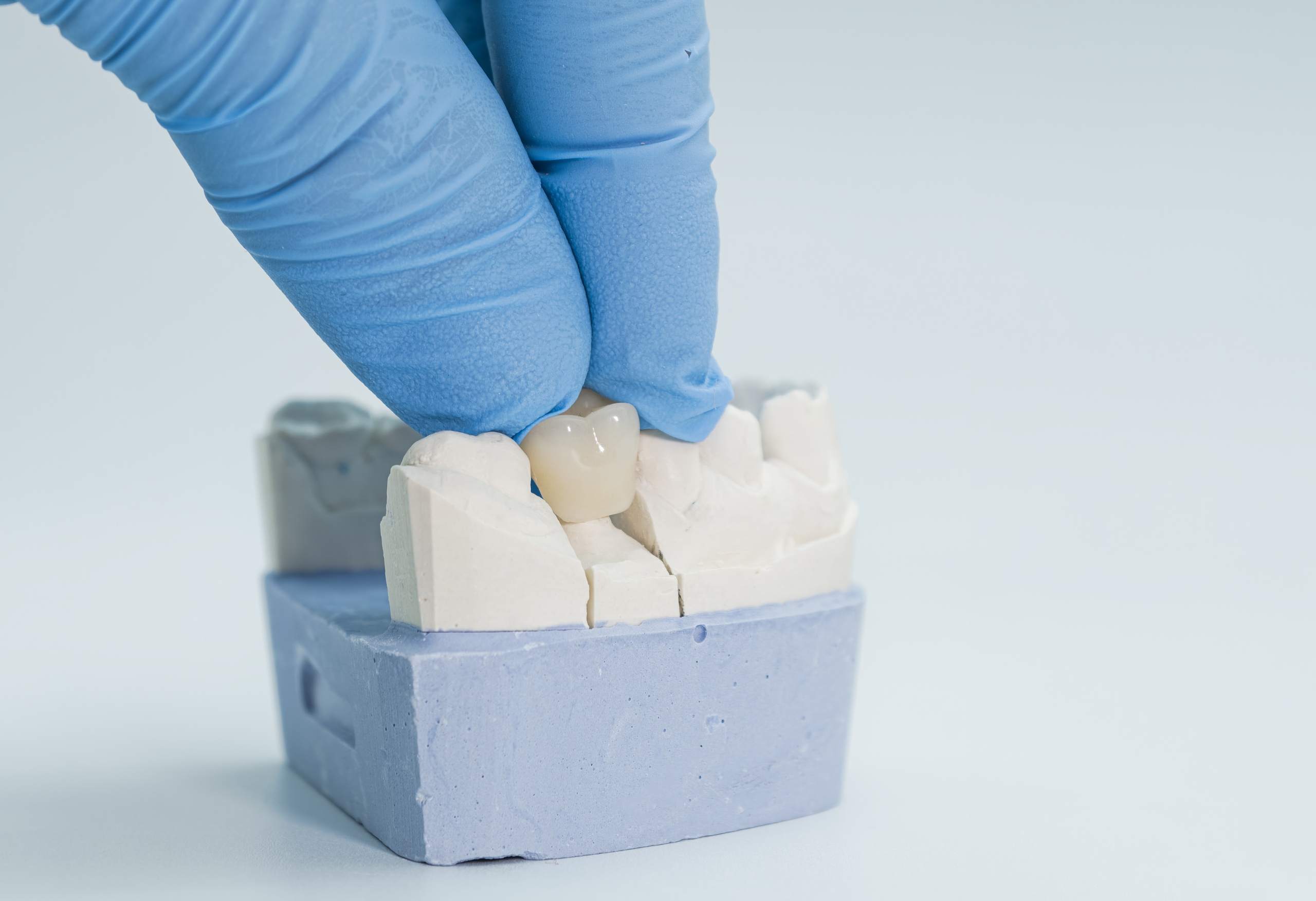 Corone Dentali: cosa sono e quando usarle - Studio Dentistico Stramesi Milano Blog