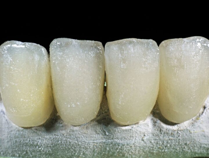 Fluorosi Dentale - Studio Dentistico Stramesi Milano Blog