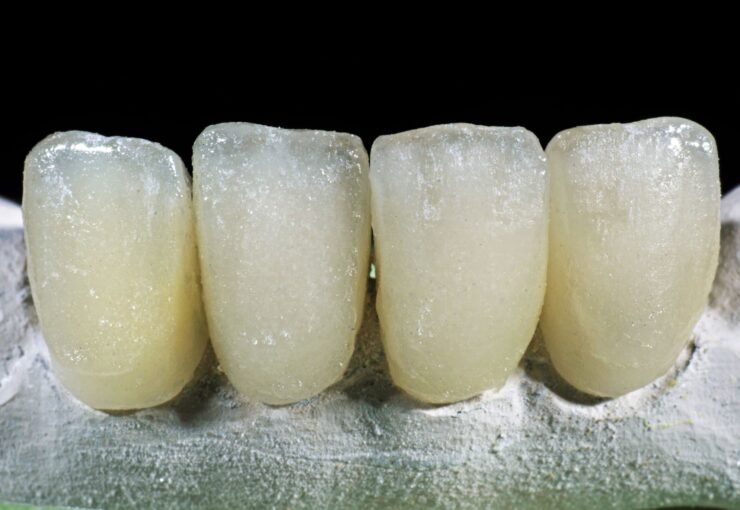 Fluorosi Dentale - Studio Dentistico Stramesi Milano Blog