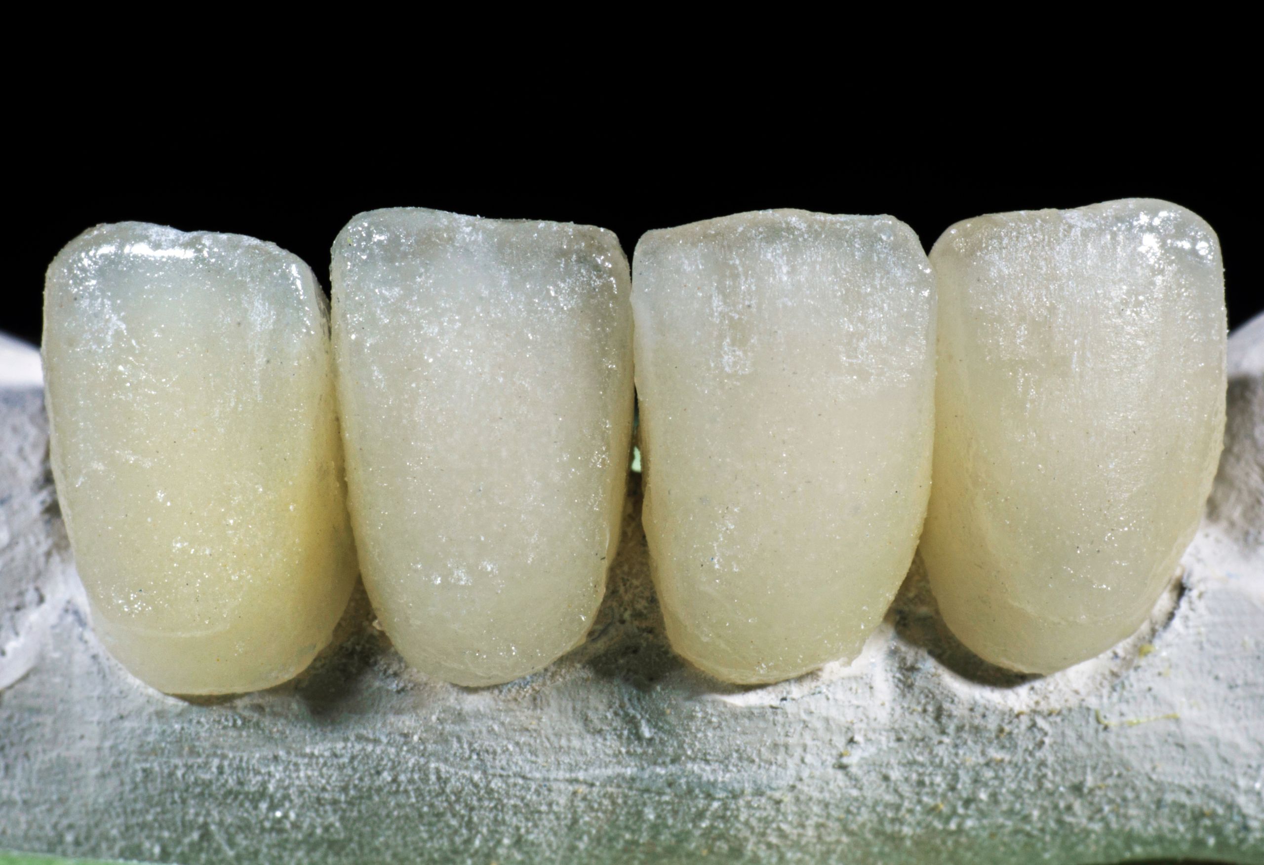 Fluorosi Dentale - Studio Dentistico Stramesi Milano Blog
