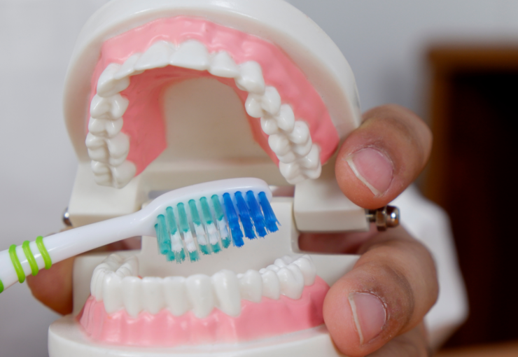 Corone, ponti e impianti: dimostrazione dello spazzolamento corretto su un modello dentale